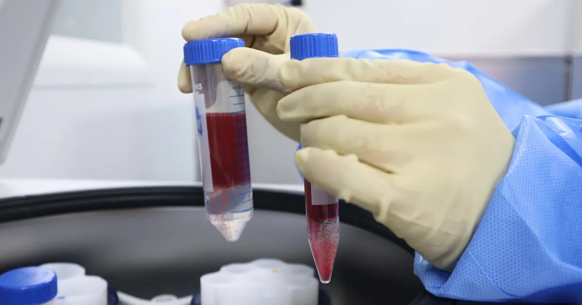 Prélèvement sanguin pour préparation de plasma riche en plaquettes (PRP)