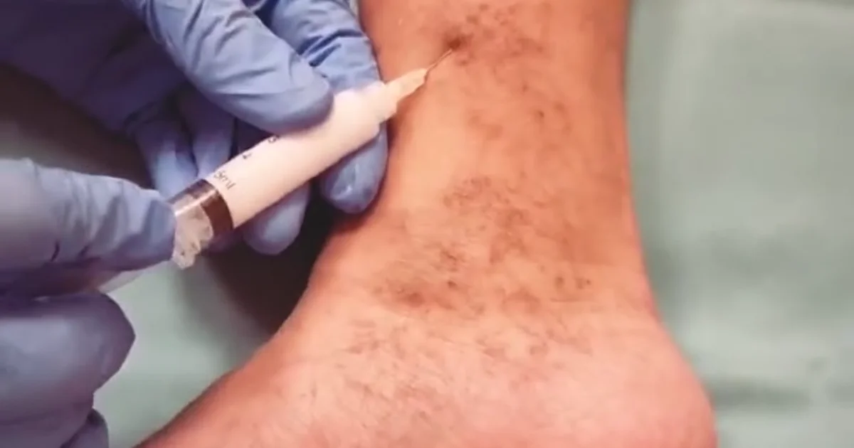 Injection de sclérothérapie sur des varicosités de la cheville par un médecin en gants bleus