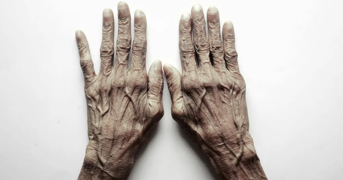 Mains d'une personne agee vues de dessus, illustrant les troubles circulatoires des extremites